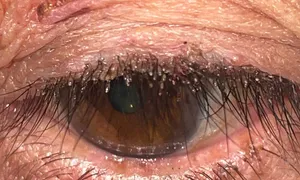 Rận làm tổ chi chít trên mắt người đàn ông Rận làm tổ chi chít trên mắt người đàn ông